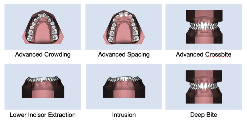 Advanced Deep Bite Correction
